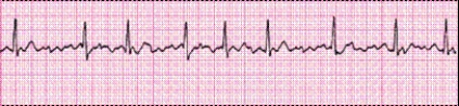 P waves in this rhythm strip _____.   A)  are upright before every QRS complex B)  are inverted before every QRS complex C)  vary in size and shape D)  are not identifiable