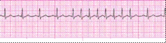 Identify the following rhythm (lead II) .   A)  Sinus arrhythmia B)  Atrial tachycardia C)  Multifocal atrial tachycardia with a PAC D)  Sinus rhythm with a PAC, a run of PSVT, back to a sinus rhythm