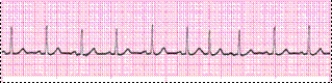 Identify the following rhythm (lead II) .   A)  Sinus arrhythmia B)  Sinus tachycardia C)  Sinus rhythm with a PAC D)  Sinus tachycardia with a PAC