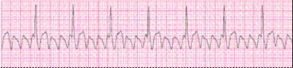 Identify the following rhythm (lead II) .   A)  Atrial flutter B)  Atrial fibrillation C)  Wolff-Parkinson-White syndrome D)  AV nodal reentrant tachycardia (AVNRT) 