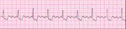 P waves in this rhythm strip _____.   A)  occur regularly B)  are not identifiable; fibrillatory waves are present C)  are upright before every QRS complex D)  are not identifiable; flutter waves are present