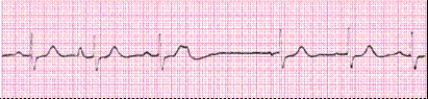 Completion -Identify the following rhythm (lead II): ____________________   