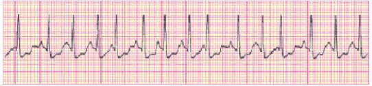 Completion -Identify the following rhythm (lead II): ____________________   