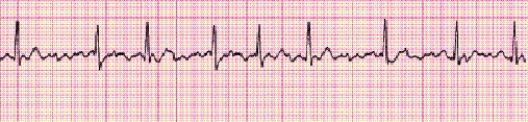 Completion -Identify the following rhythm (lead II): ____________________   