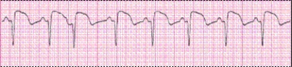 Completion -Identify the following rhythm (lead II): ____________________   