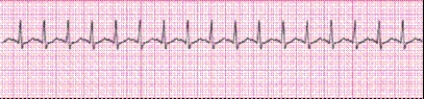Completion -Identify the following rhythm (lead II): ____________________   