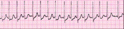 Completion -Identify the following rhythm (lead II): ____________________   