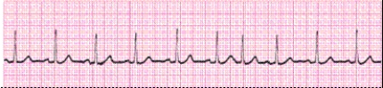 Completion -Identify the following rhythm (lead II): ____________________   