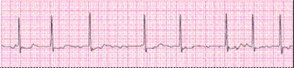 Completion -Identify the following rhythm (lead II): ____________________   