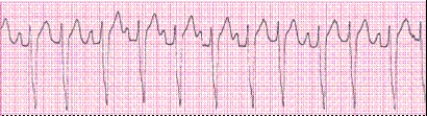 Completion -Identify the following rhythm (lead II): ____________________   