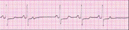 Completion -Identify the following rhythm (lead II): ____________________   