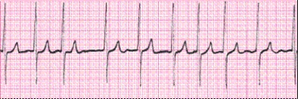 Completion -Identify the following rhythm (lead II): ____________________   