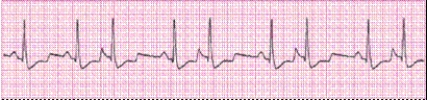 Completion -Identify the following rhythm (lead II): ____________________   