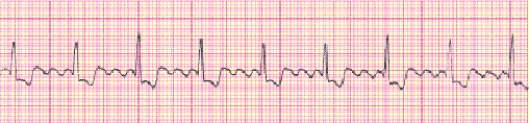 Completion -Identify the following rhythm (lead III): ____________________   