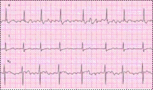 Completion -Identify the following rhythm: ____________________   
