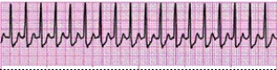 Completion -Identify the following rhythm (lead II): ____________________   