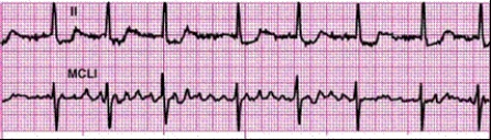 Completion -Identify the following rhythm: ____________________   
