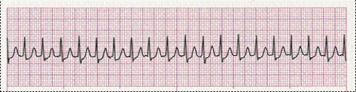 Completion -Identify the following rhythm (lead II): ____________________   