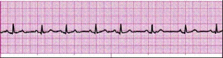 Completion -Identify the following rhythm (lead II): ____________________   