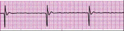Completion -Identify the following rhythm (lead II): ____________________   