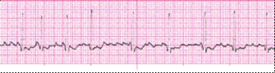 Identify the following rhythm (lead II): ____________________