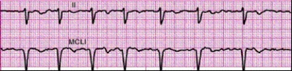Completion -Identify the following rhythm: ____________________   