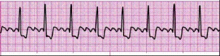 Completion -Identify the following rhythm: ____________________   