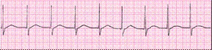 Identify the following rhythm (lead II) .   A)  Accelerated junctional rhythm B)  Sinus rhythm C)  Junctional rhythm D)  Sinus arrhythmia