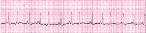 Identify the following rhythm (lead II) .   A)  Sinus arrhythmia B)  Sinus rhythm with junctional escape beats C)  Sinus tachycardia with premature atrial complexes D)  Sinus tachycardia with premature junctional complexes