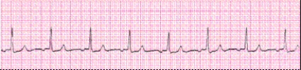 Identify the following rhythm (lead II) .   A)  Junctional tachycardia B)  Sinus rhythm with PACs C)  Sinus rhythm with PJCs D)  Accelerated junctional rhythm