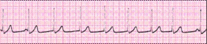 Identify the following rhythm (lead II): ____________________   