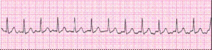 Identify the following rhythm (lead II): ____________________