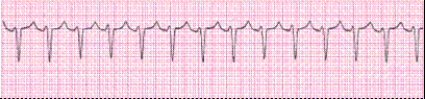 Identify the following rhythm (lead II): ____________________   