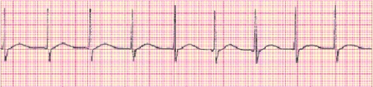 Identify the following rhythm (lead II): ____________________   
