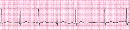 Identify the following rhythm (lead II): ____________________   