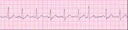 Identify the following rhythm (lead II): ____________________   