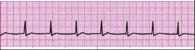 Identify the following rhythm (lead II): ____________________   