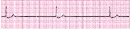 Identify the following rhythm (lead II): ____________________   