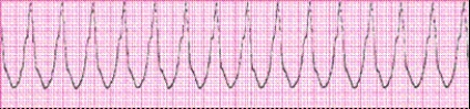 Identify the following rhythm (lead II): ____________________   