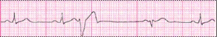Identify the following rhythm (lead II): ____________________   