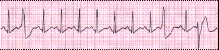Identify the following rhythm (lead II): ____________________   