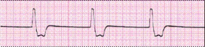Identify the following rhythm (lead II): ____________________   
