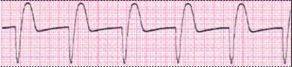 Identify the following rhythm (lead II): ____________________   