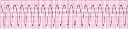Identify the following rhythm (lead II): ____________________   