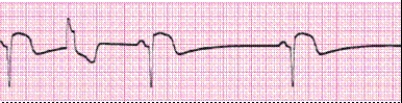 Identify the following rhythm (lead II): ____________________   