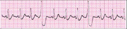 Identify the following rhythm (lead II): ____________________   