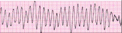 Identify the following rhythm (lead II): ____________________   
