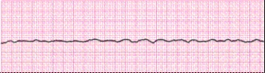 Identify the following rhythm (lead II): ____________________   