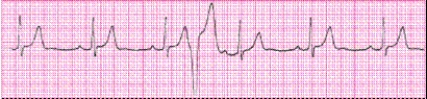 Identify the following rhythm (lead II): ____________________   