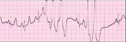 Identify the following rhythm (lead II): ____________________   